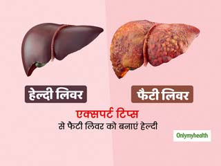4 फूड और 45 मिनट की हल्की एक्सरसाइज नॉन-एल्‍कोहॉलिक फैटी लिवर से दिला सकती है छुटकारा, जानें एक्सपर्ट से